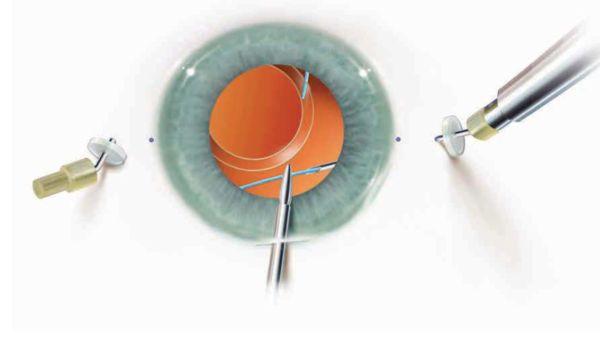 Scleral IOL Fixation Solutions Pack